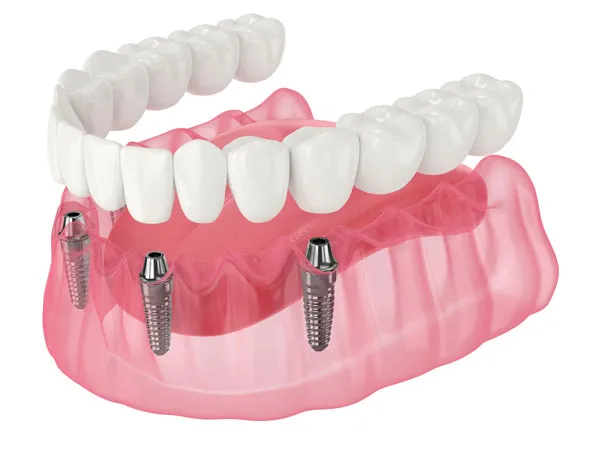 Rendering of All on X dental implants in the lower jaw Rendering of All on X dental implants in the lower jaw
