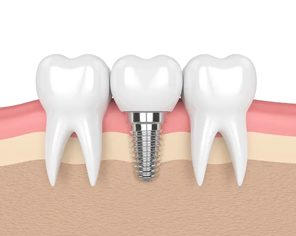 3D rendered cross-section view of a dental implant placed in the jaw between two healthy teeth 3D rendered cross-section view of a dental implant placed in the jaw between two healthy teeth