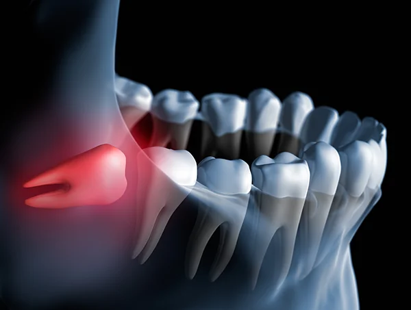 3D rendered x-ray of an impacted wisdom tooth (highlighted in red) butting against the tooth next to it 3D rendered x-ray of an impacted wisdom tooth (highlighted in red) butting against the tooth next to it